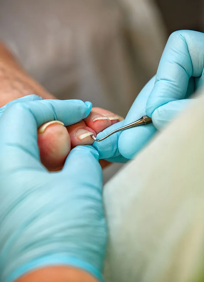 Podologikum Mauritz - Behandlung Schritt 1