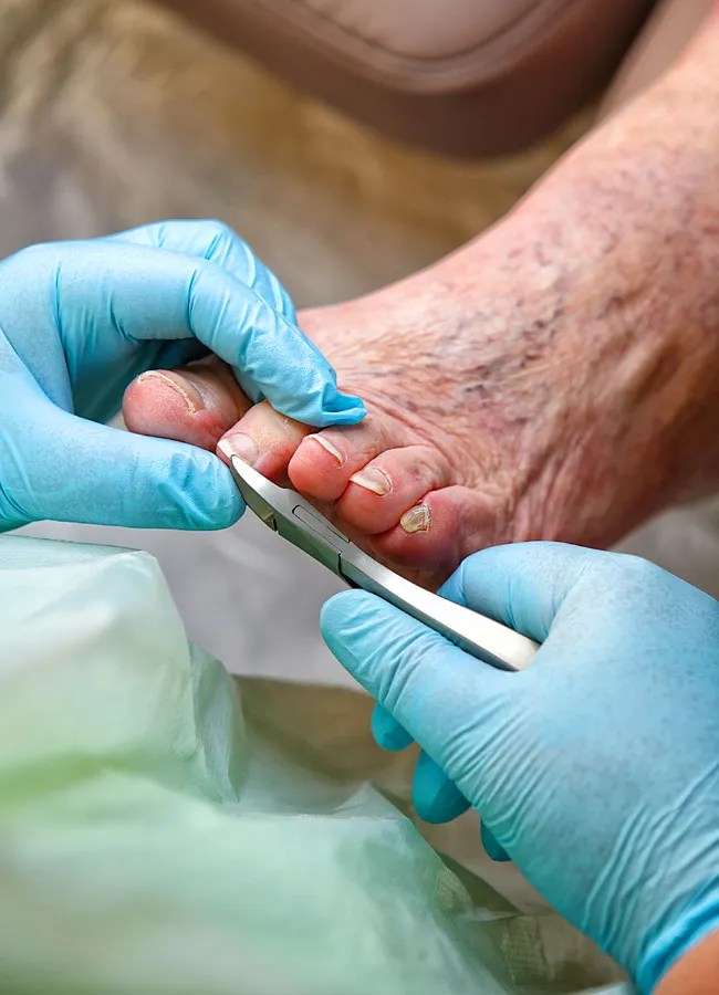 Podologikum Mauritz - Behandlung Schritt 2