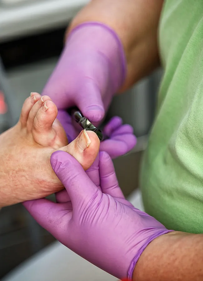 Podologikum Mauritz - Behandlung Schritt 1