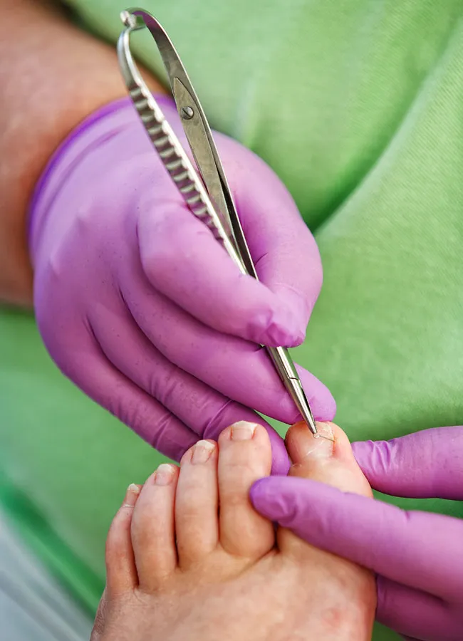 Podologikum Mauritz - Behandlung Schritt 2