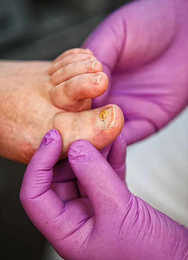 Podologikum Mauritz - Behandlung Schritt 5