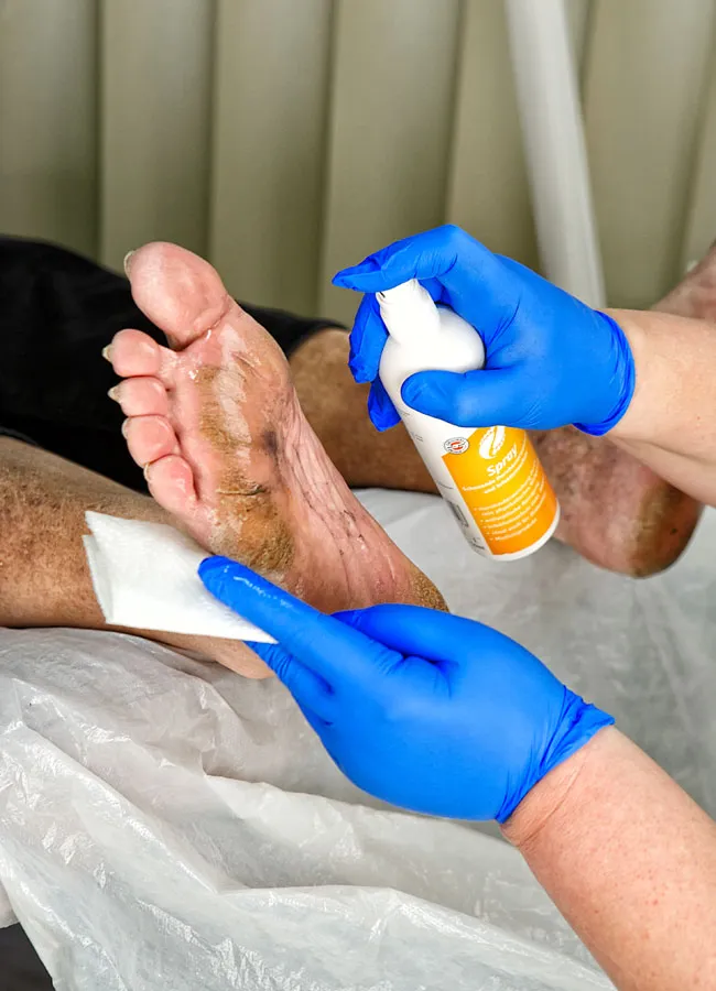 Podologikum Mauritz - Behandlung Schritt 1