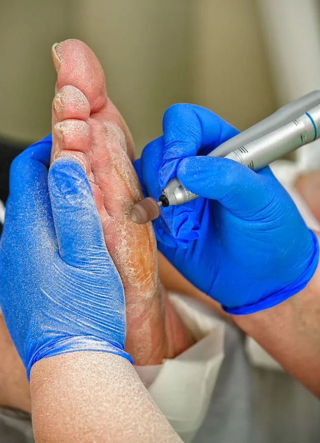 Podologikum Mauritz - Behandlung Schritt 4