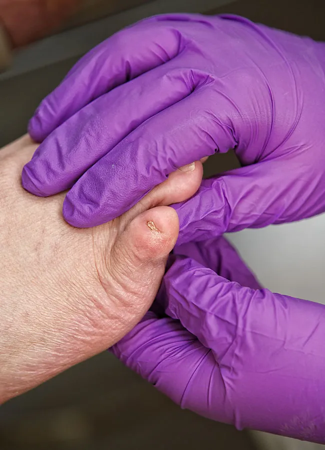 Podologikum Mauritz - Behandlung Schritt 1