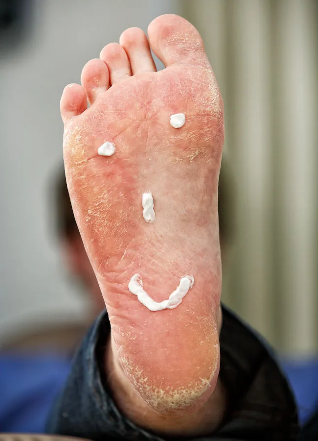 Podologikum Mauritz - Behandlung Schritt 5